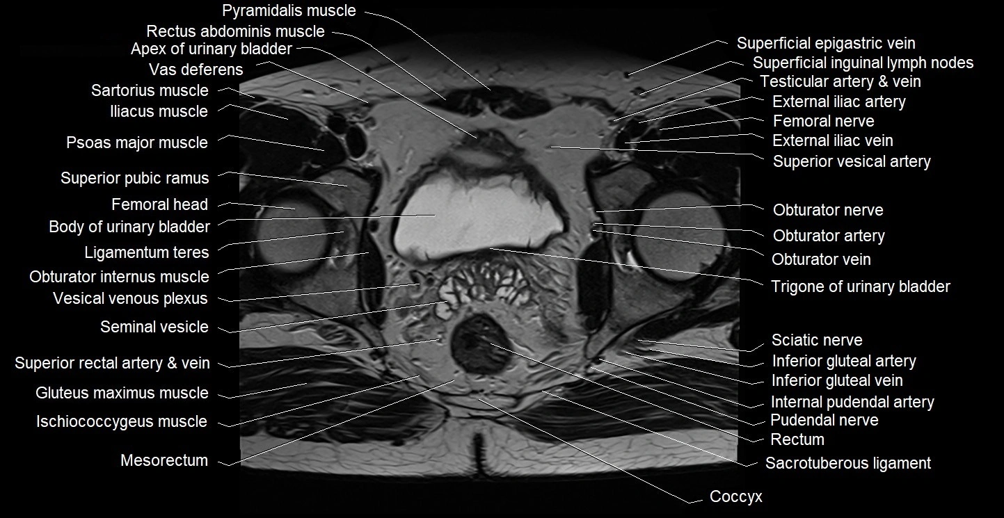 Male pelvis axial cross sectional anatomy image 26.webp